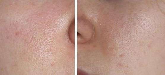 rasshirennye_pory_foto-3